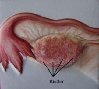 Polikistik Over Sendromu (PKOS)